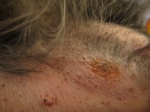 skin lesions